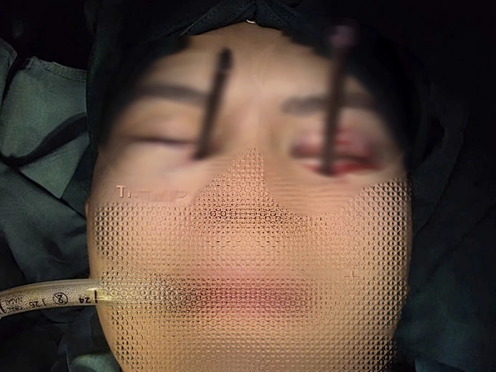 Cứu nam thanh niên bị 2 chiếc đũa đâm sâu vào 2 hốc mắt